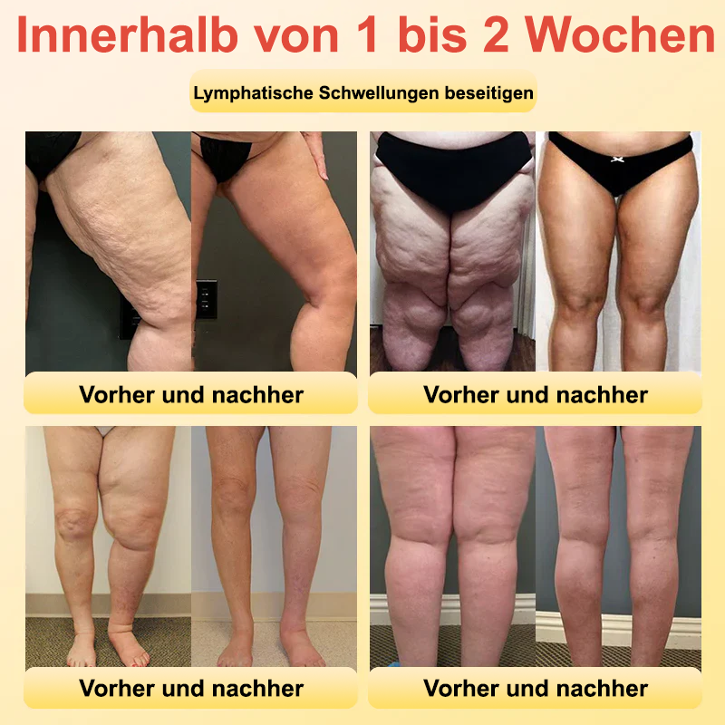 ✅Offizieller Laden:𝐅𝐑𝐎𝐏𝐔𝐍™ 👩‍⚕️Bienengift Lymphdrainage Schlankheitspflaster(TÜV) Clearance（Behandlung von Fettleibigkeit, schlaffer Haut, Krampfadern und Dehnungsstreifen）