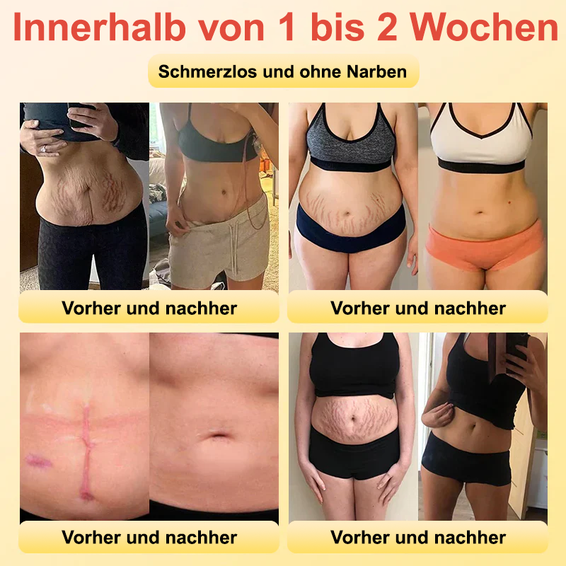 ✅Offizieller Laden:𝐅𝐑𝐎𝐏𝐔𝐍™ 👩‍⚕️Bienengift Lymphdrainage Schlankheitspflaster(TÜV) Clearance（Behandlung von Fettleibigkeit, schlaffer Haut, Krampfadern und Dehnungsstreifen）