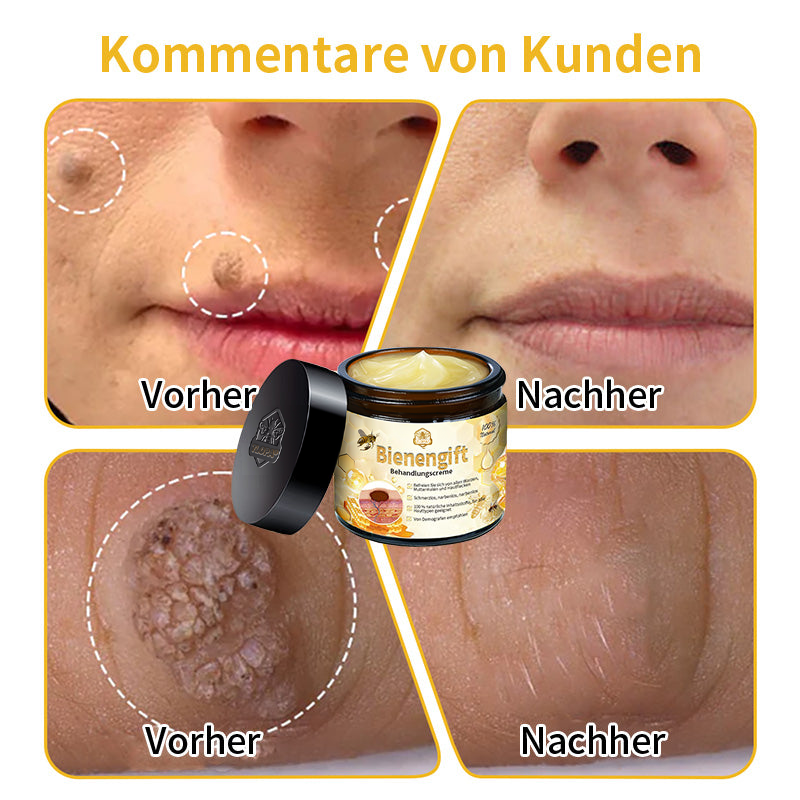 ✅[𝐎𝐟𝐟𝐢𝐳𝐢𝐞𝐥𝐥𝐞𝐫 𝐋𝐚𝐝𝐞𝐧]:5 Tage zu makelloser Haut 👩‍⚕️ 𝐷𝑜𝑟𝑚𝑜𝑟𝑛𝑎™𝑩𝒊𝒆𝒏𝒆𝒏𝒈𝒊𝒇𝒕 𝑴𝒂𝒖𝒍𝒘𝒖𝒓𝒇 & 𝑾𝒂𝒓𝒛𝒆 𝑬𝒏𝒕𝒇𝒆𝒓𝒏𝒖𝒏𝒈 𝑪𝒓𝒆𝒎𝒆 (𝐄𝐧𝐣𝐨𝐲 𝟑𝟎% 𝐨𝐟𝐟 𝐧𝐨𝐰! 𝐋𝐢𝐦𝐢𝐭𝐞𝐝 𝐭𝐢𝐦𝐞 𝐨𝐟𝐟𝐞𝐫!)